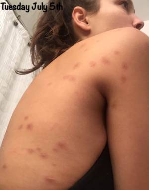 Figure 2: Brazilian model-Sabrina Jales, showing her bed bug bites that she acquired while staying at a hotel in Palm Desert, CA